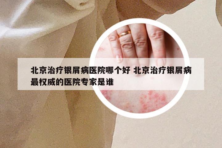 北京治疗银屑病医院哪个好 北京治疗银屑病最权威的医院专家是谁