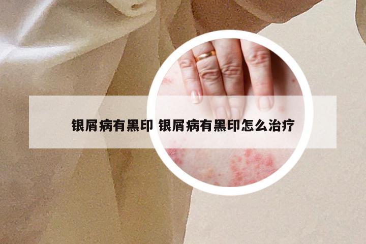 银屑病有黑印 银屑病有黑印怎么治疗