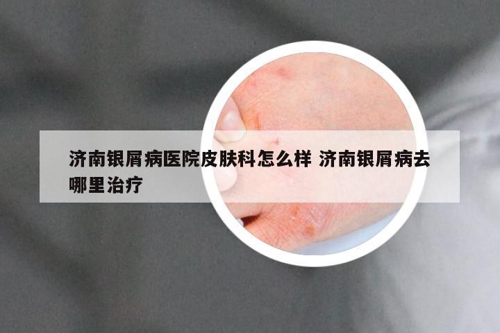 济南银屑病医院皮肤科怎么样 济南银屑病去哪里治疗