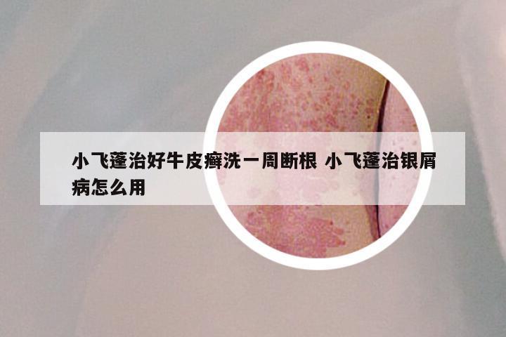 小飞蓬治好牛皮癣洗一周断根 小飞蓬治银屑病怎么用