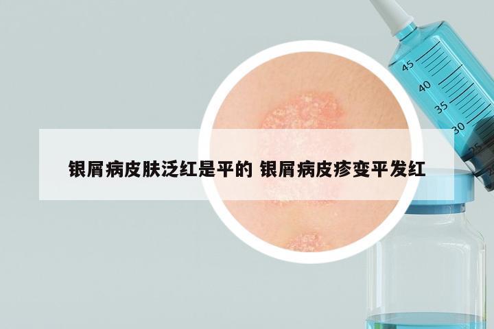银屑病皮肤泛红是平的 银屑病皮疹变平发红