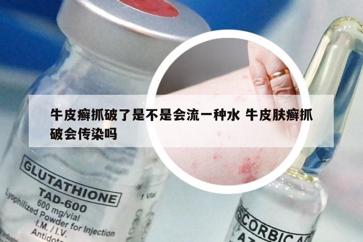 牛皮癣抓破了是不是会流一种水 牛皮肤癣抓破会传染吗