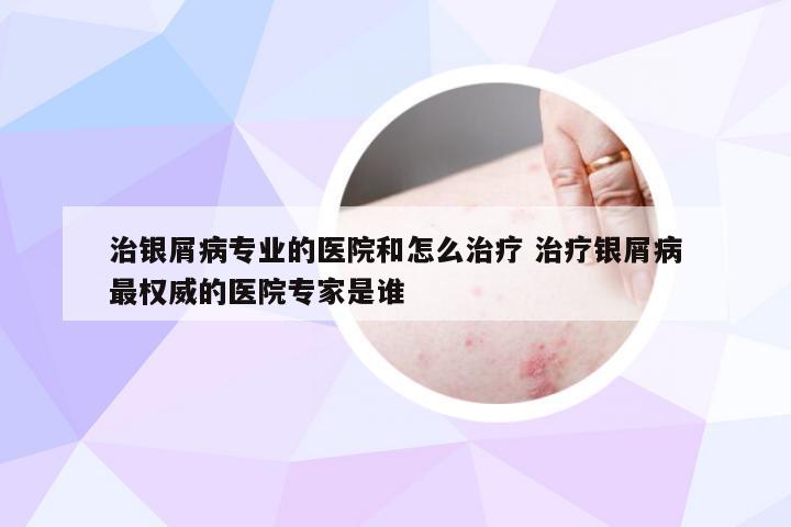 治银屑病专业的医院和怎么治疗 治疗银屑病最权威的医院专家是谁