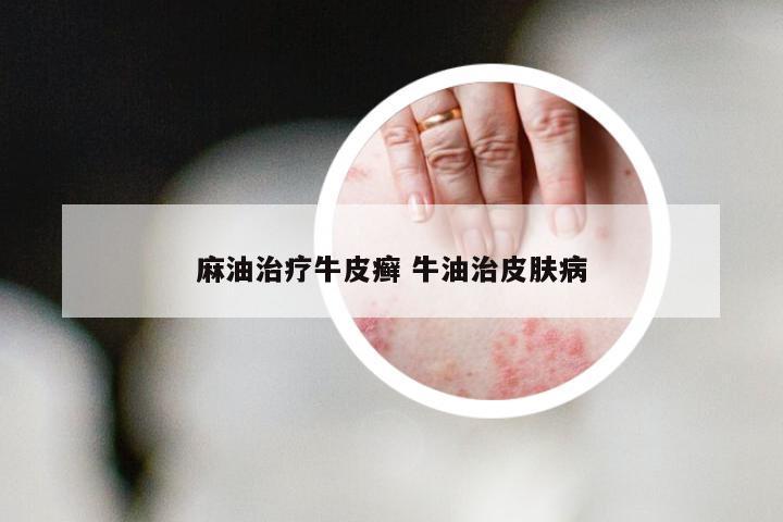 麻油治疗牛皮癣 牛油治皮肤病