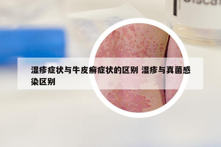 湿疹症状与牛皮癣症状的区别 湿疹与真菌感染区别