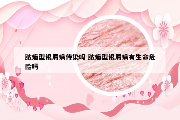 脓疱型银屑病传染吗 脓疱型银屑病有生命危险吗