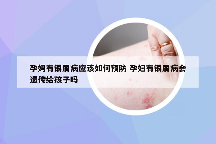 孕妈有银屑病应该如何预防 孕妇有银屑病会遗传给孩子吗