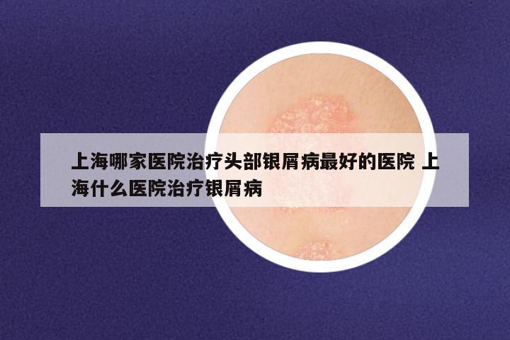 上海哪家医院治疗头部银屑病最好的医院 上海什么医院治疗银屑病