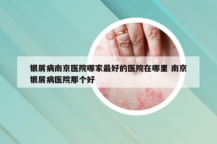 银屑病南京医院哪家最好的医院在哪里 南京银屑病医院那个好
