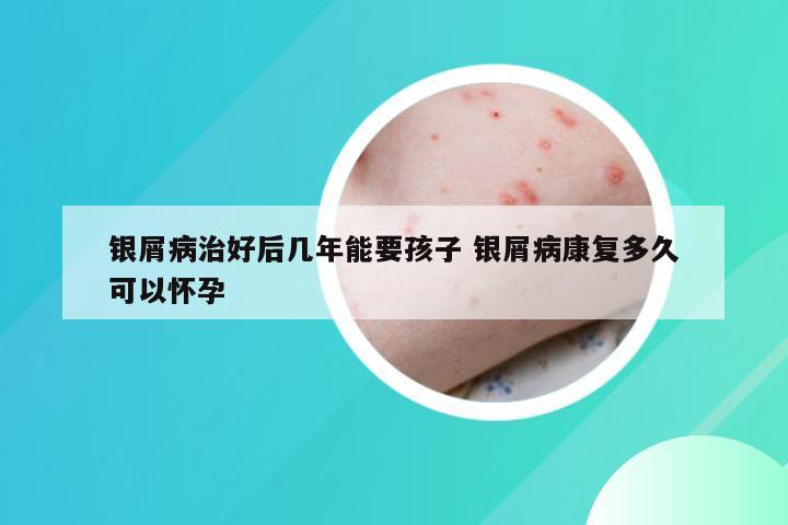 银屑病治好后几年能要孩子 银屑病康复多久可以怀孕