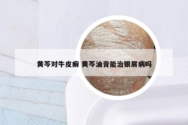 黄芩对牛皮癣 黄芩油膏能治银屑病吗