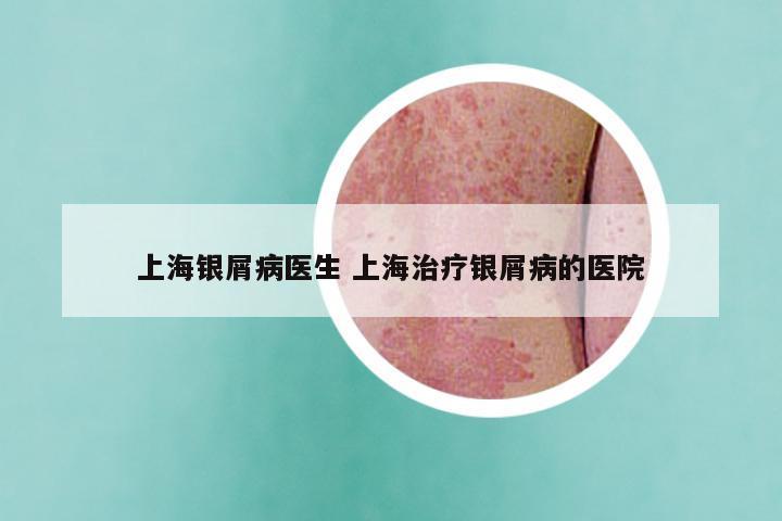 上海银屑病医生 上海治疗银屑病的医院