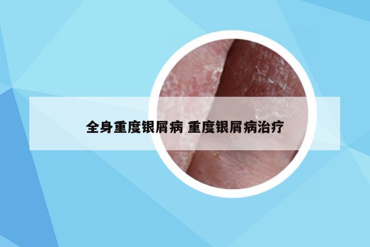 全身重度银屑病 重度银屑病治疗