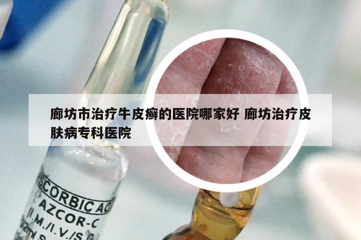 廊坊市治疗牛皮癣的医院哪家好 廊坊治疗皮肤病专科医院