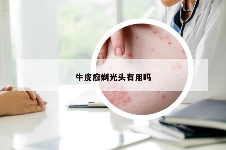 牛皮癣剃光头有用吗