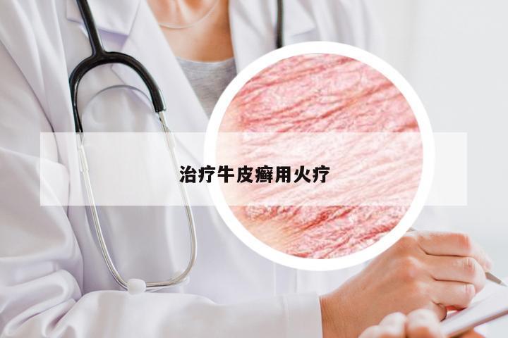治疗牛皮癣用火疗