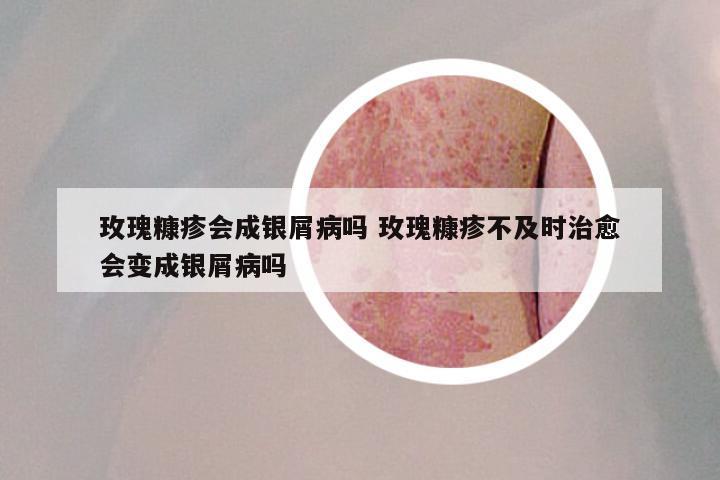 玫瑰糠疹会成银屑病吗 玫瑰糠疹不及时治愈会变成银屑病吗