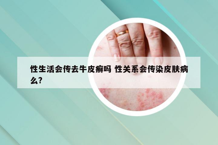 性生活会传去牛皮癣吗 性关系会传染皮肤病么?