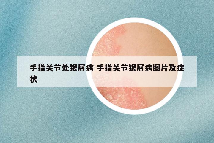 手指关节处银屑病 手指关节银屑病图片及症状