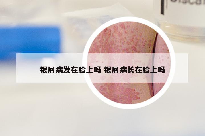 银屑病发在脸上吗 银屑病长在脸上吗
