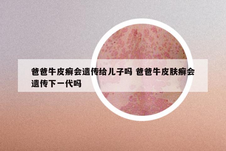 爸爸牛皮癣会遗传给儿子吗 爸爸牛皮肤癣会遗传下一代吗