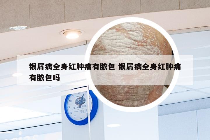 银屑病全身红肿痛有脓包 银屑病全身红肿痛有脓包吗