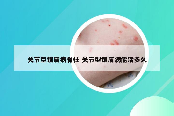 关节型银屑病脊柱 关节型银屑病能活多久