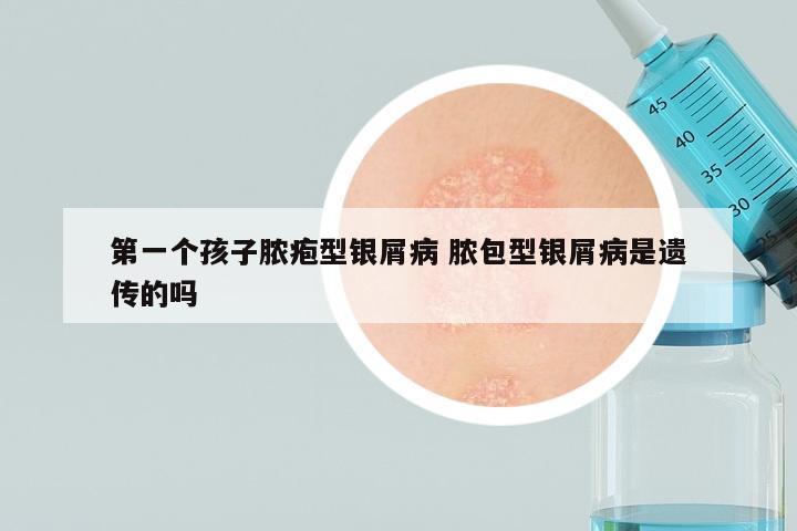 第一个孩子脓疱型银屑病 脓包型银屑病是遗传的吗