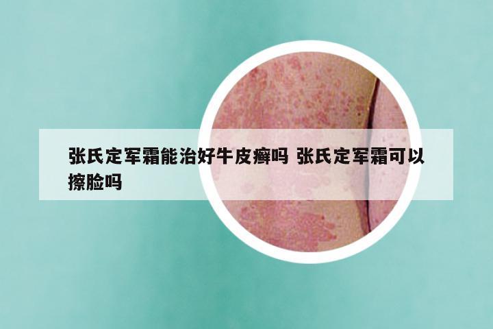 张氏定军霜能治好牛皮癣吗 张氏定军霜可以擦脸吗
