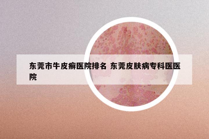 东莞市牛皮癣医院排名 东莞皮肤病专科医医院