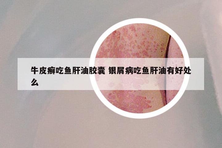 牛皮癣吃鱼肝油胶囊 银屑病吃鱼肝油有好处么