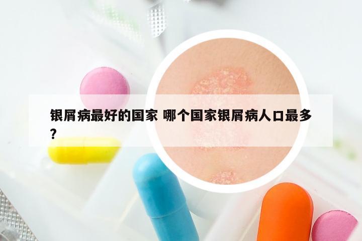 银屑病最好的国家 哪个国家银屑病人口最多?