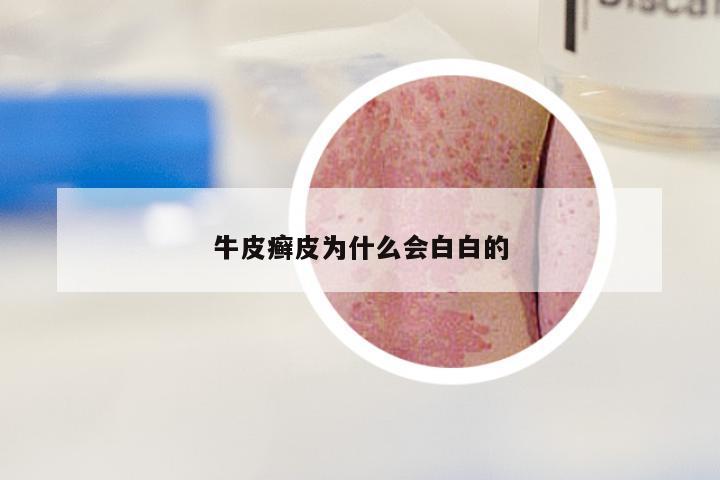 牛皮癣皮为什么会白白的