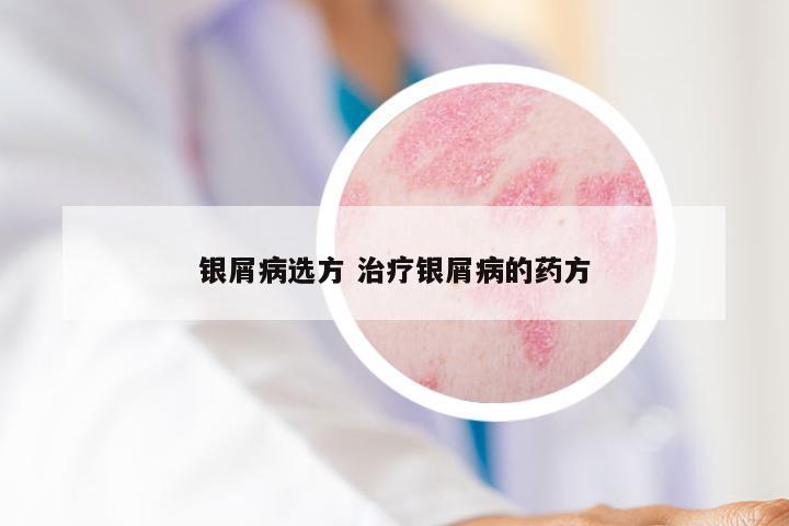 银屑病选方 治疗银屑病的药方