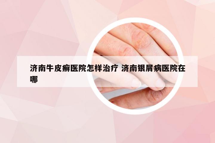 济南牛皮癣医院怎样治疗 济南银屑病医院在哪