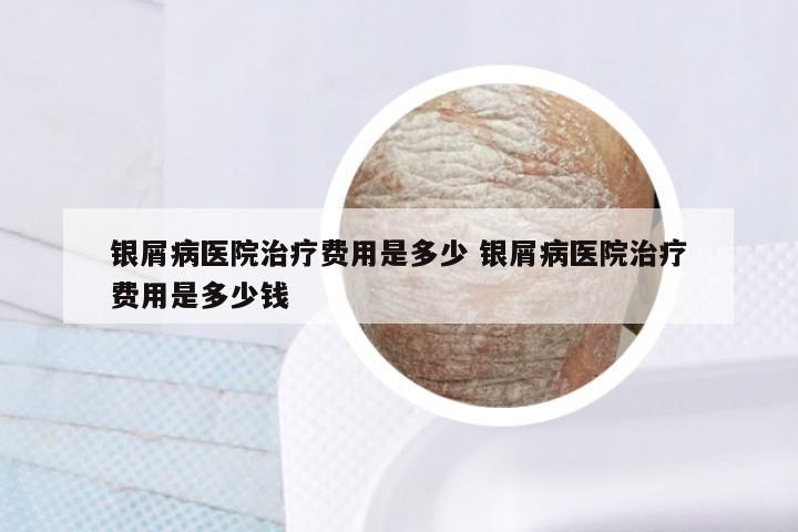 银屑病医院治疗费用是多少 银屑病医院治疗费用是多少钱