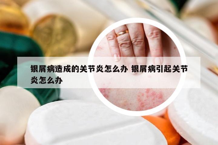 银屑病造成的关节炎怎么办 银屑病引起关节炎怎么办