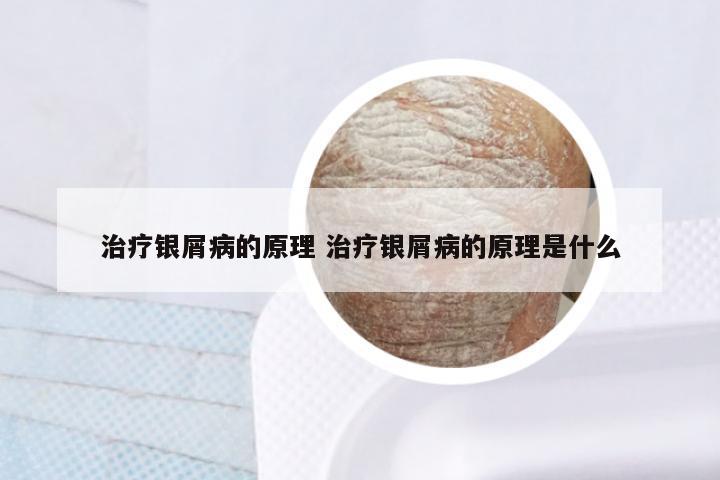 治疗银屑病的原理 治疗银屑病的原理是什么