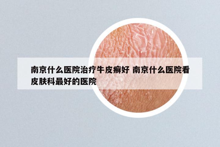 南京什么医院治疗牛皮癣好 南京什么医院看皮肤科最好的医院