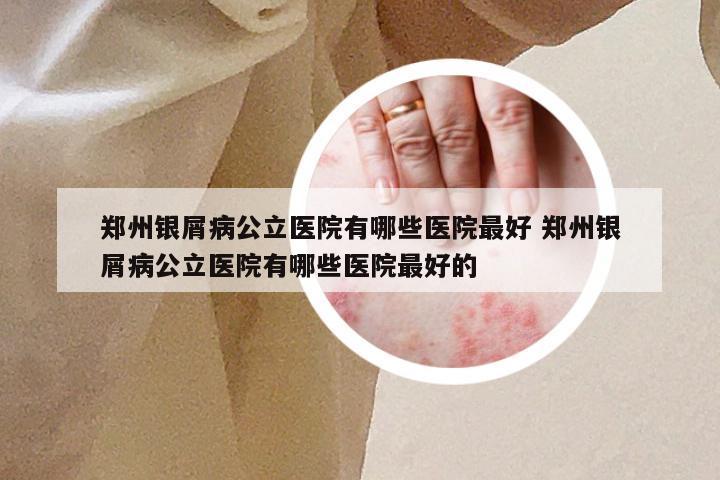 郑州银屑病公立医院有哪些医院最好 郑州银屑病公立医院有哪些医院最好的