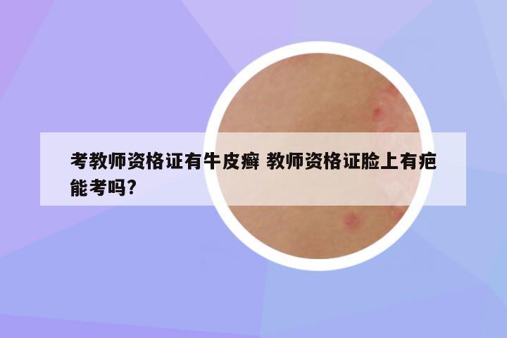 考教师资格证有牛皮癣 教师资格证脸上有疤能考吗?