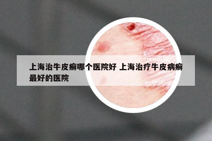 上海治牛皮癣哪个医院好 上海治疗牛皮病癣最好的医院