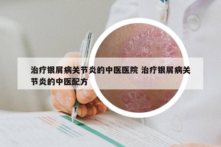 治疗银屑病关节炎的中医医院 治疗银屑病关节炎的中医配方