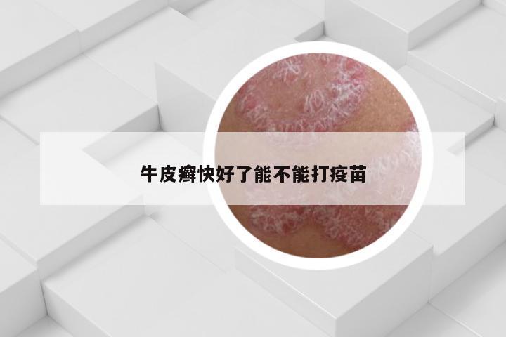 牛皮癣快好了能不能打疫苗
