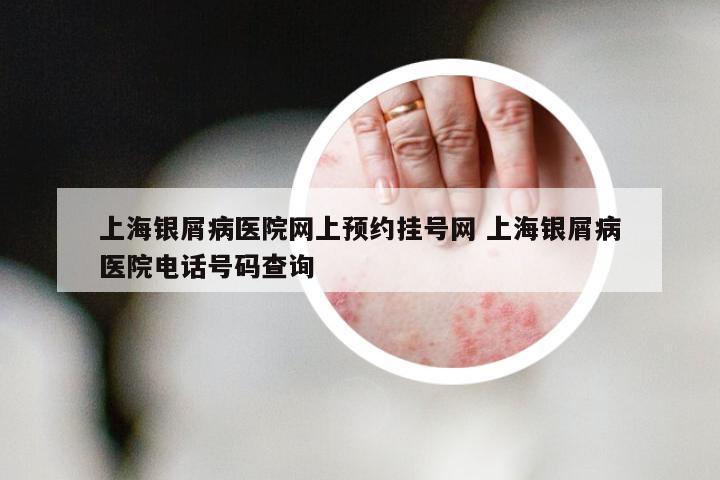 上海银屑病医院网上预约挂号网 上海银屑病医院电话号码查询