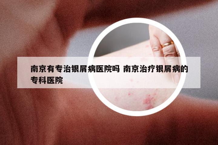 南京有专治银屑病医院吗 南京治疗银屑病的专科医院