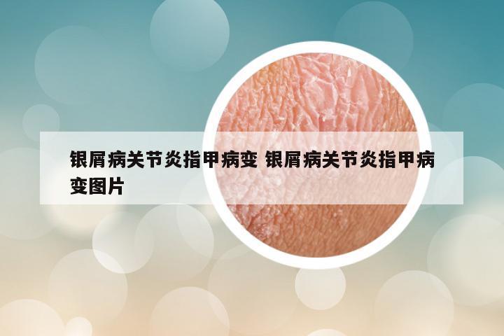 银屑病关节炎指甲病变 银屑病关节炎指甲病变图片