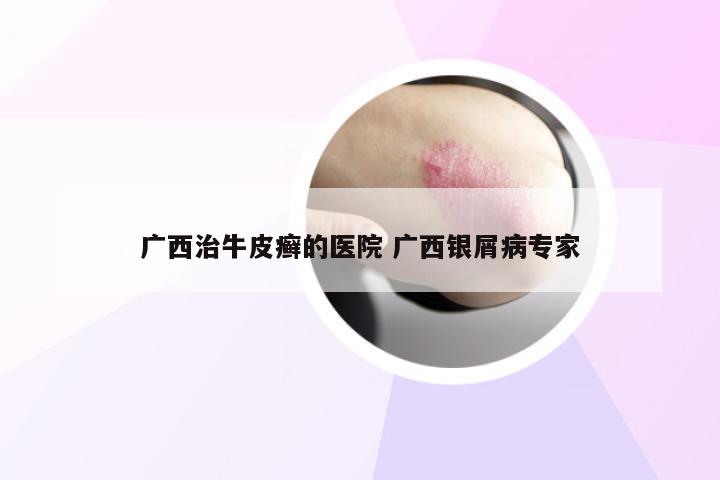 广西治牛皮癣的医院 广西银屑病专家