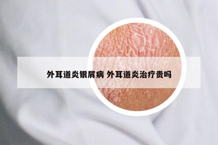 外耳道炎银屑病 外耳道炎治疗贵吗