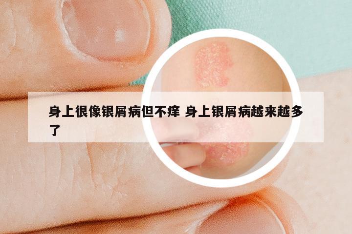 身上很像银屑病但不痒 身上银屑病越来越多了